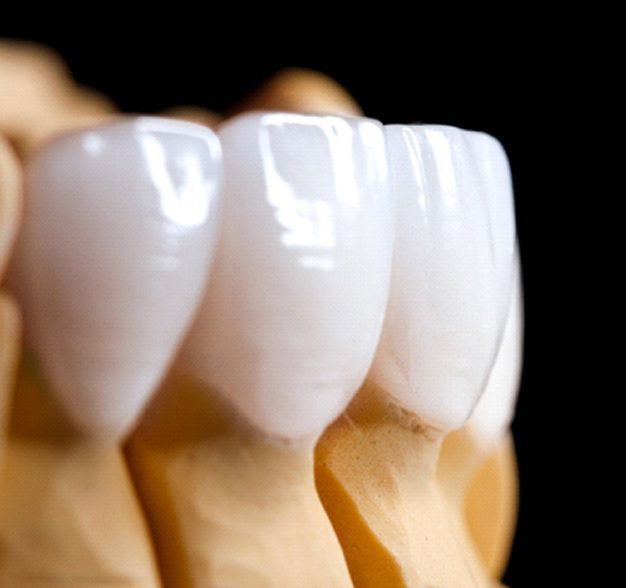 veneers and aesthetic dental restorations Classic Dental Lab