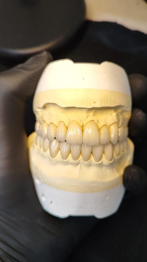 porcelain fused bridge Classic Dental Lab Kent