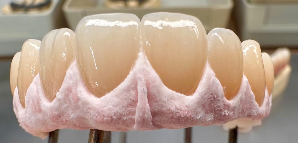 porcelain fused bridge Classic Dental Lab Kent
