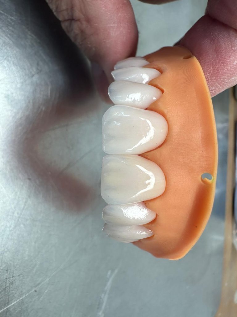 porcelain fused to metal bridge Classic Dental Lab Kent