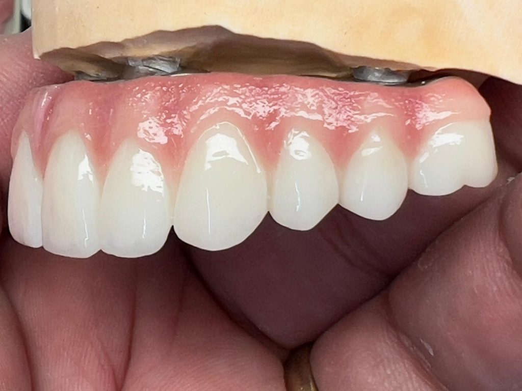 Full arch implant restoration All-on-X UK dental lab