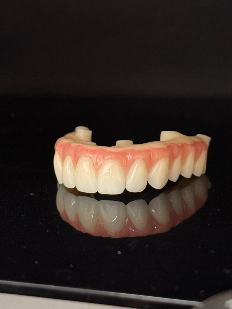 arch implant restoration All