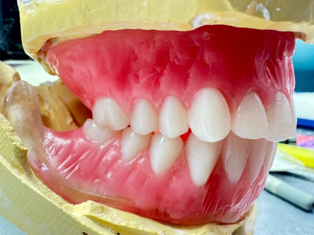 complete denture precision made UK dental lab Folkestone