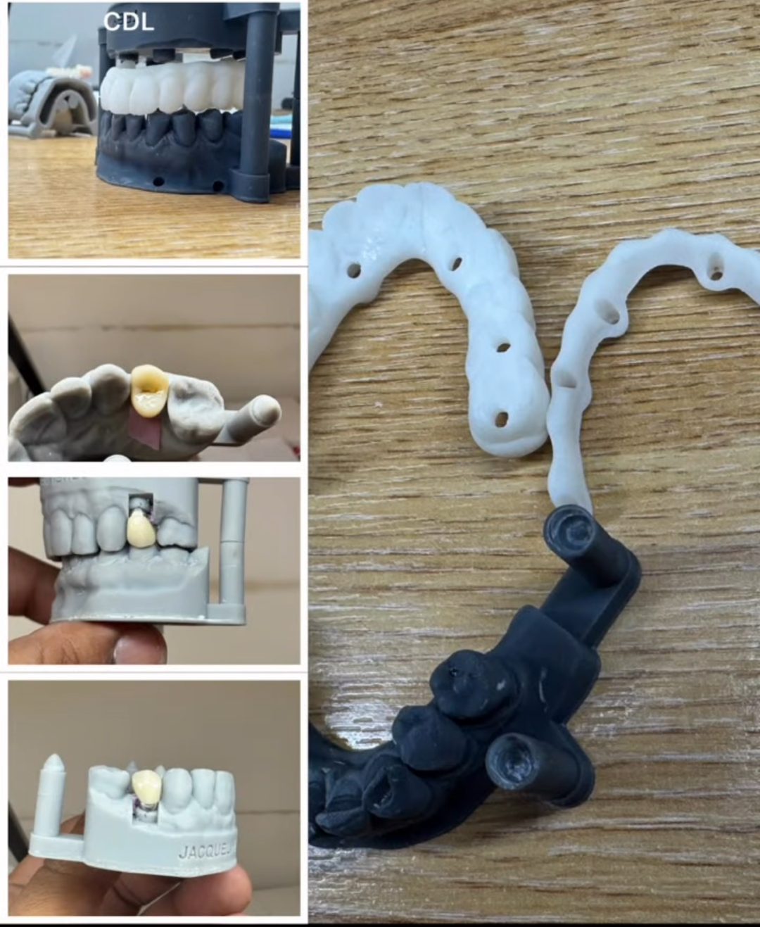 zirconia crown and porcelain bridge handcrafted by Classic Dental Lab dental technician Folkestone Kent
