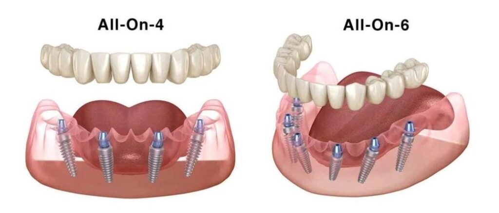 Diagram comparing All-On-4 and All-On-6 dental implants showing implant placement in the jaw
