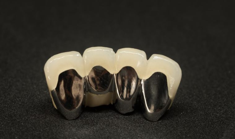 PFM Metal-ceramic dental bridge restoration with porcelain crowns displayed on a black background.