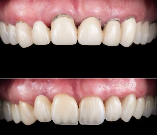 Zirconia VS PFM comparison of dental crowns showing the appearance of restored front teeth.